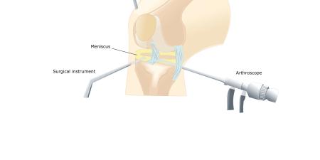 arthroscopic lavage