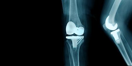 arthroplasty